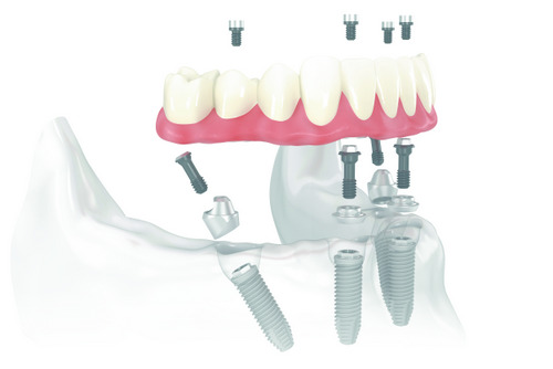 Diagram of All on 4 offered at Wheaton Oral Surgery in Naperville, IL