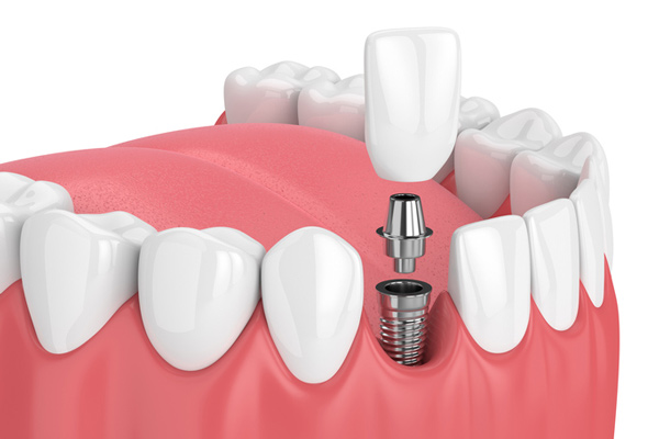 Diagram of a single dental implant