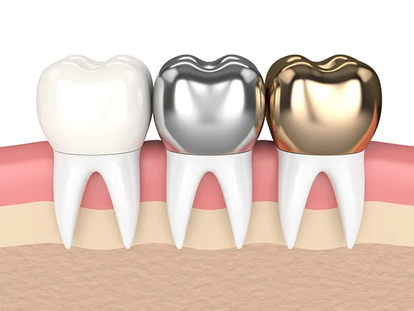 3D rendered cross-section view of three teeth with dental crowns made of different materials at Wheaton Oral Surgery in Naperville, IL