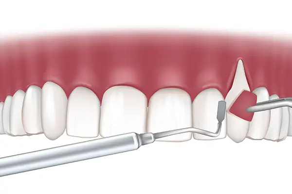 A gum grafting procedure showing an incision being made to reposition gum tissue over exposed teeth.