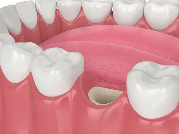 Close-up view of a dental ridge showing a missing tooth area and the bone deficiency before ridge augmentation.