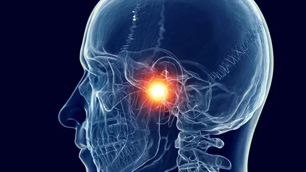 An X-ray of a human skull with the TMJ area highlighted in orange, representing pain or dysfunction.