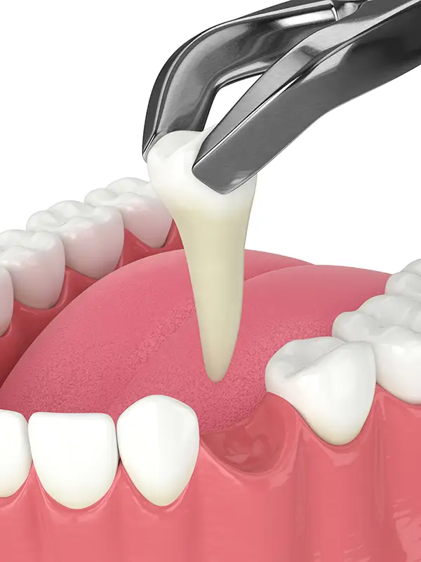 A dental tool extracting a front tooth from the gum, focusing on the roots and oral tissue.